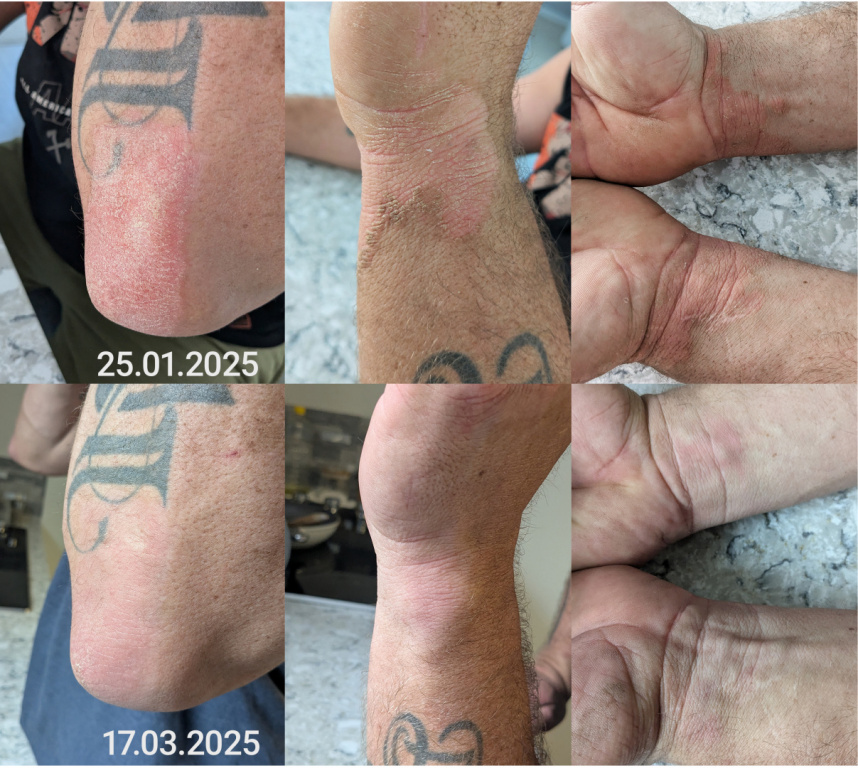 Eczema