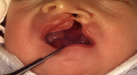 Левосторонняя расщелина верхней губы, альвеолярного отростка и нёба